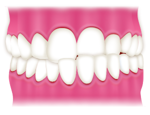 歯並びの一部が反対（交叉咬合）