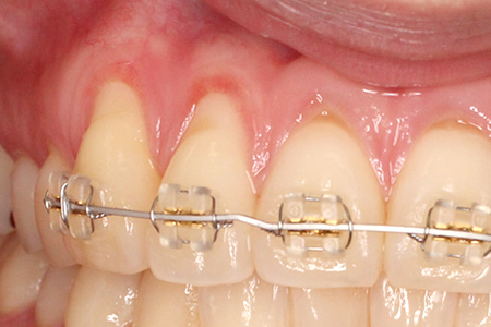 ブラケット矯正の副作用
